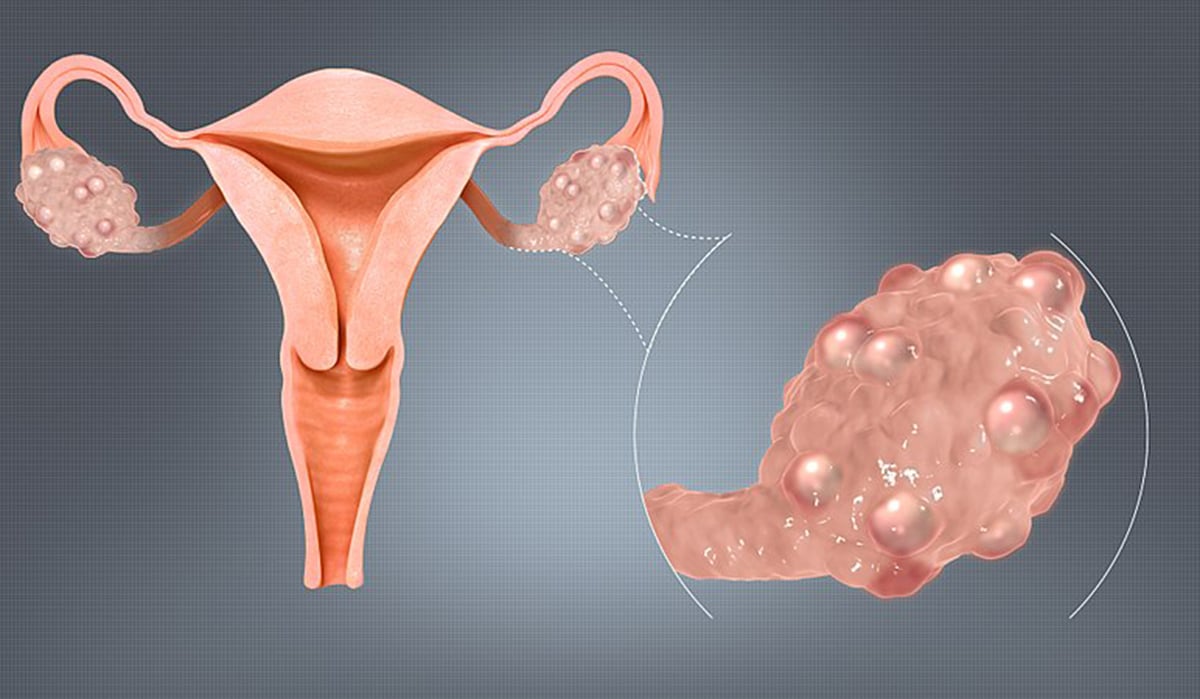 Polycystic Ovaries pcos syndrome image
