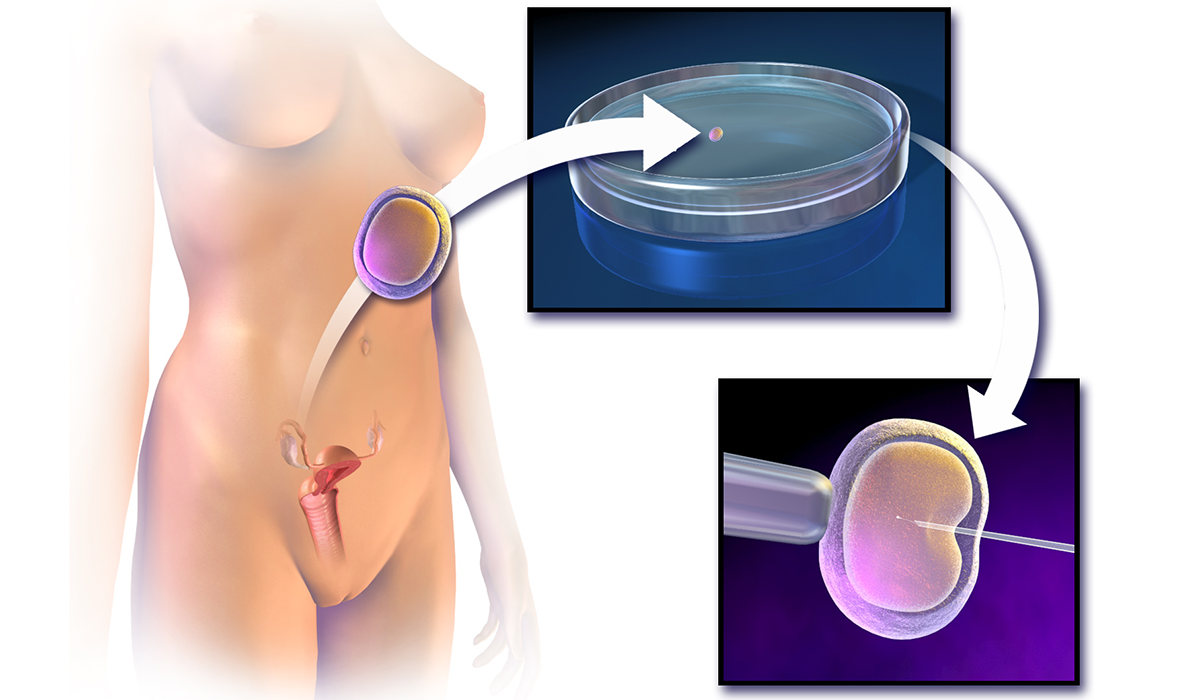 intracytoplasmic sperm injection ivf technique