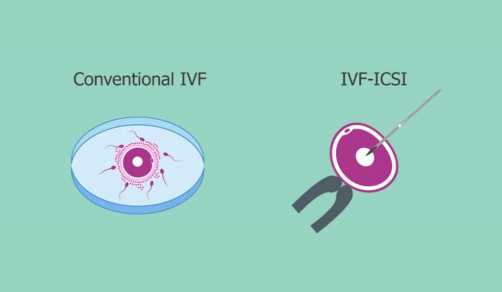 ICSI vs IVF image