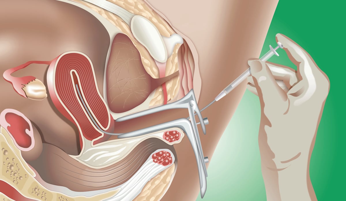 IUI insemination image