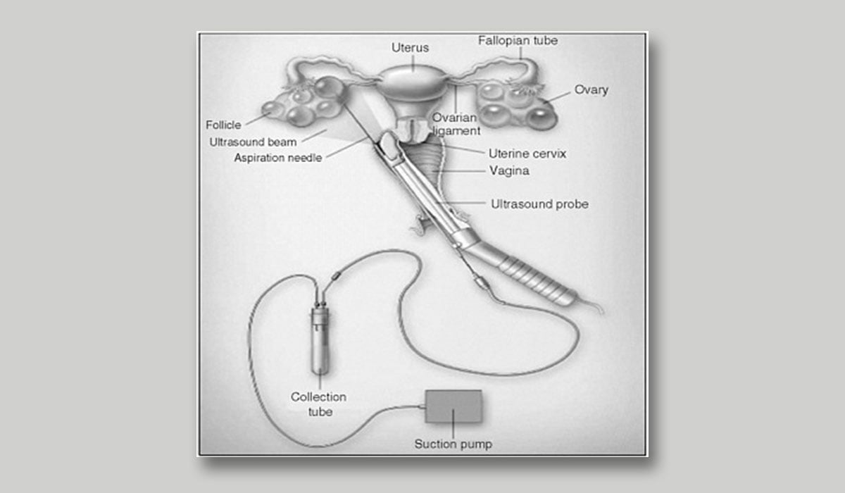 egg donation risks during egg retrieval