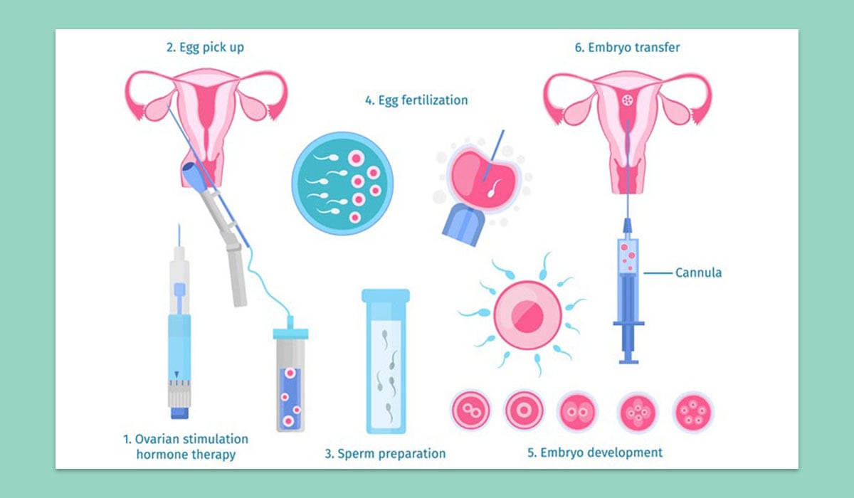 ivf process - embryo transfer image