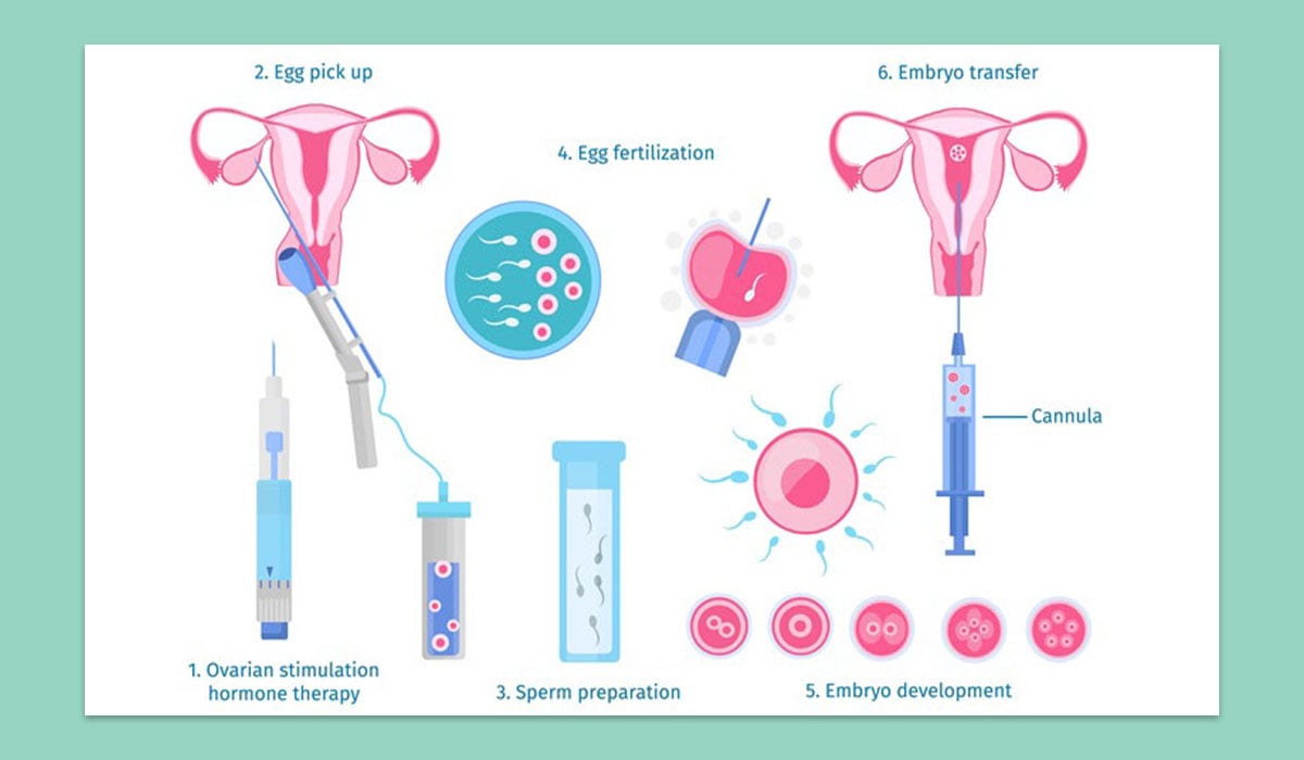 How Much Does IVF Cost in Your Country? - All Prices Revealed