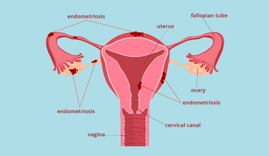 endometriosis and infertility - female reproductive organs image