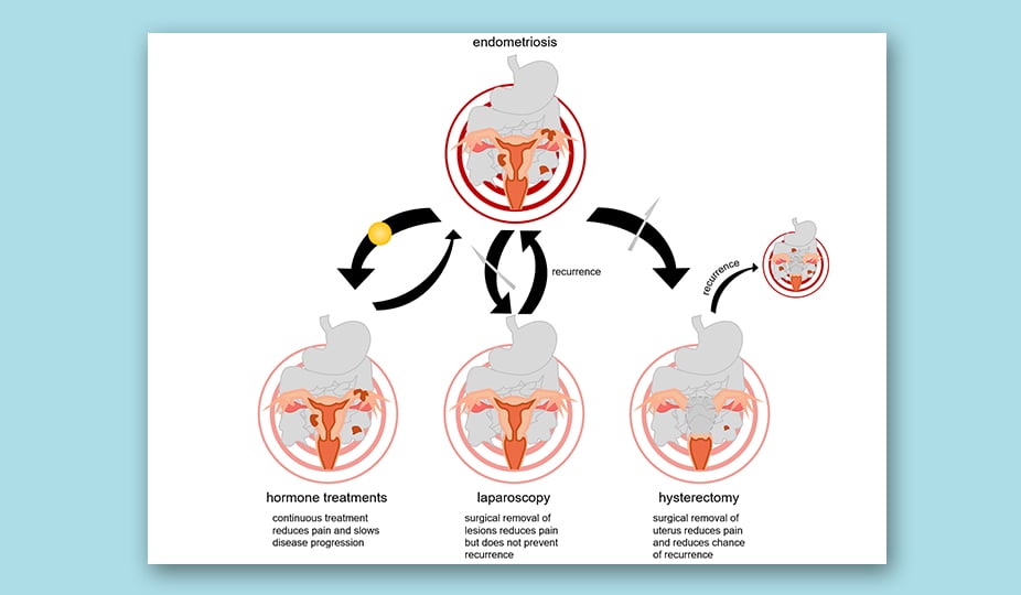 endometriosis medication and diagnostic ways