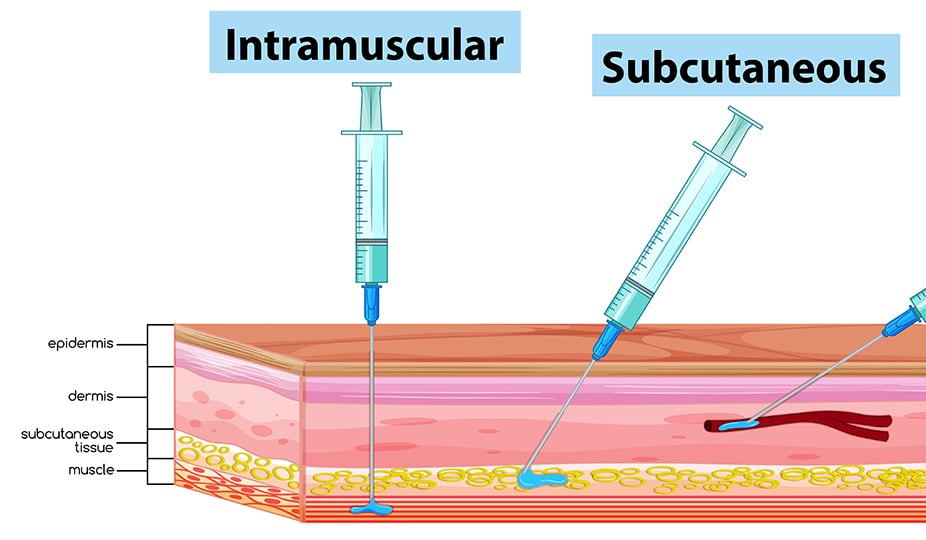 Types of IVF injections - intramuscular and subcutaneous