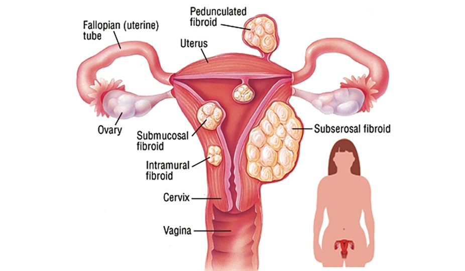 uterine fibroids medical image