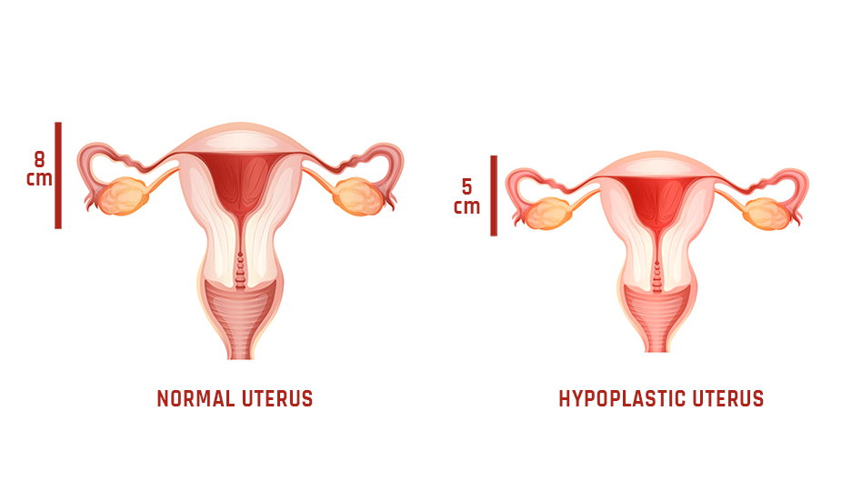 normal vs hypoplastic uterus