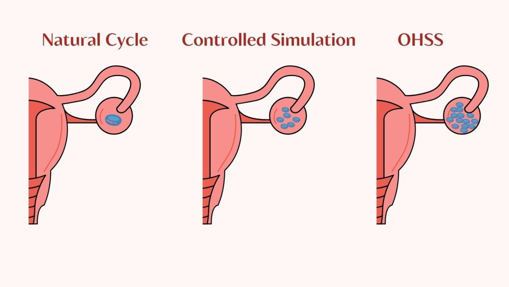 OHSS Types of ovarian stimulation: Mild , moderate, severe, critical
