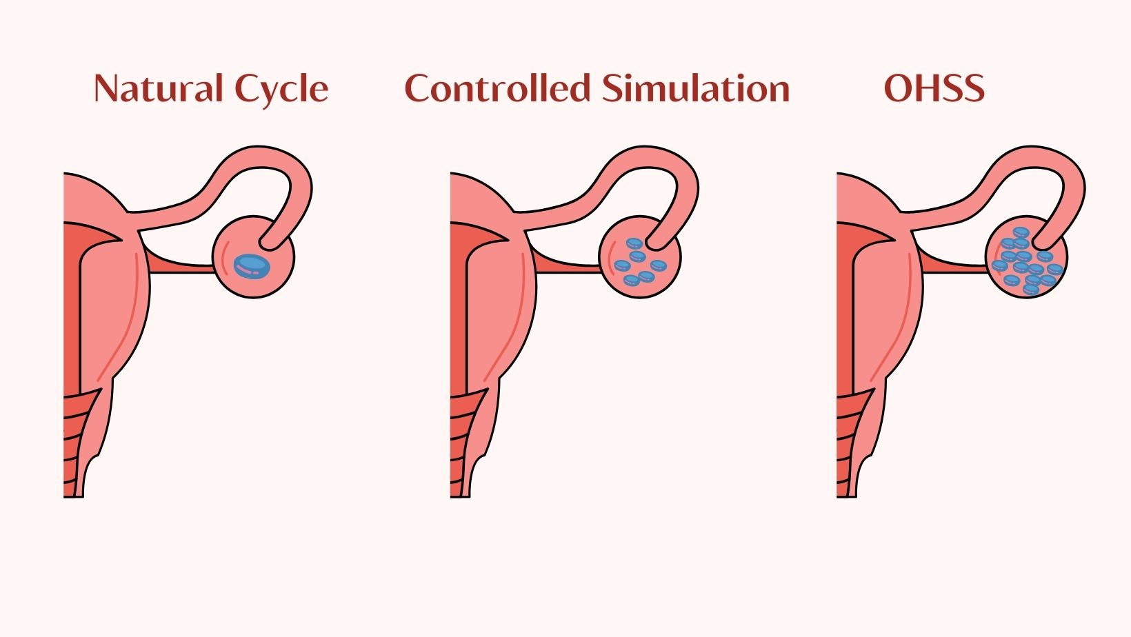 Ohss Classification Ovarian Hyperstimulation Syndrome (OHSS) - Symptoms & Risks